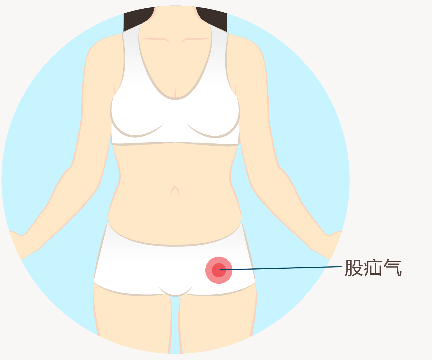 股疝气