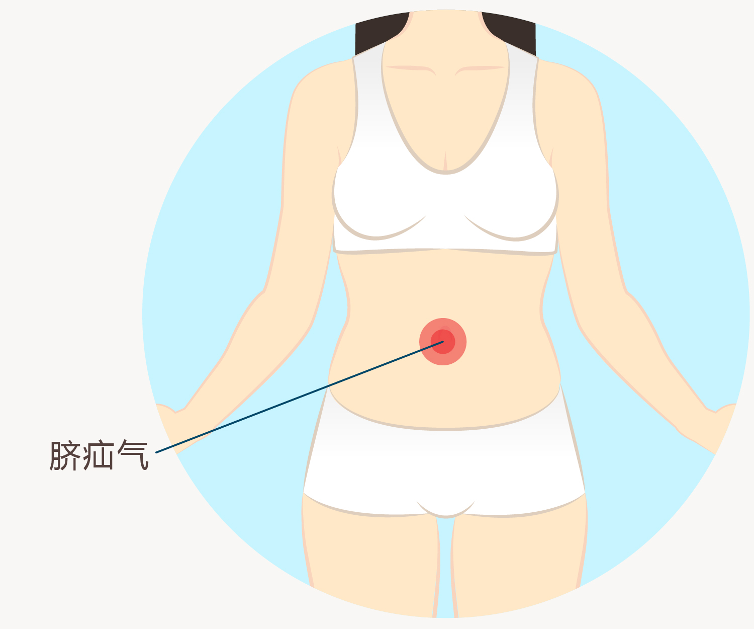 脐疝气