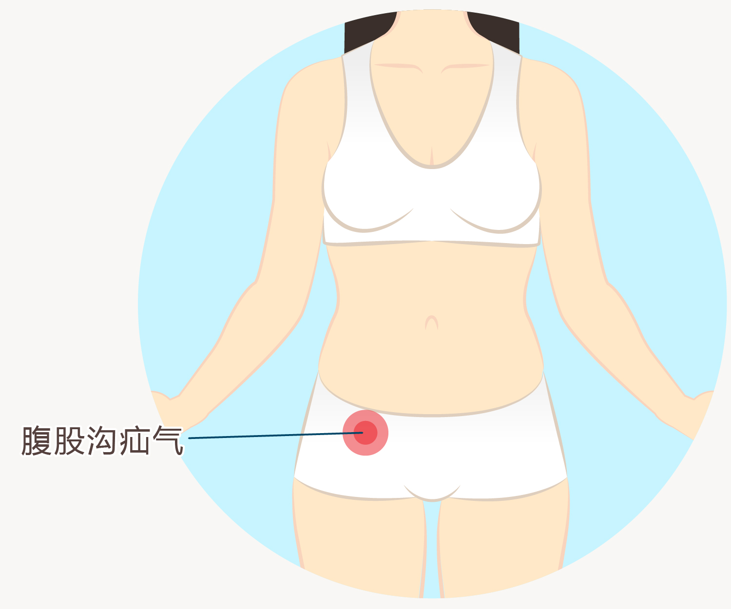 腹股沟疝气