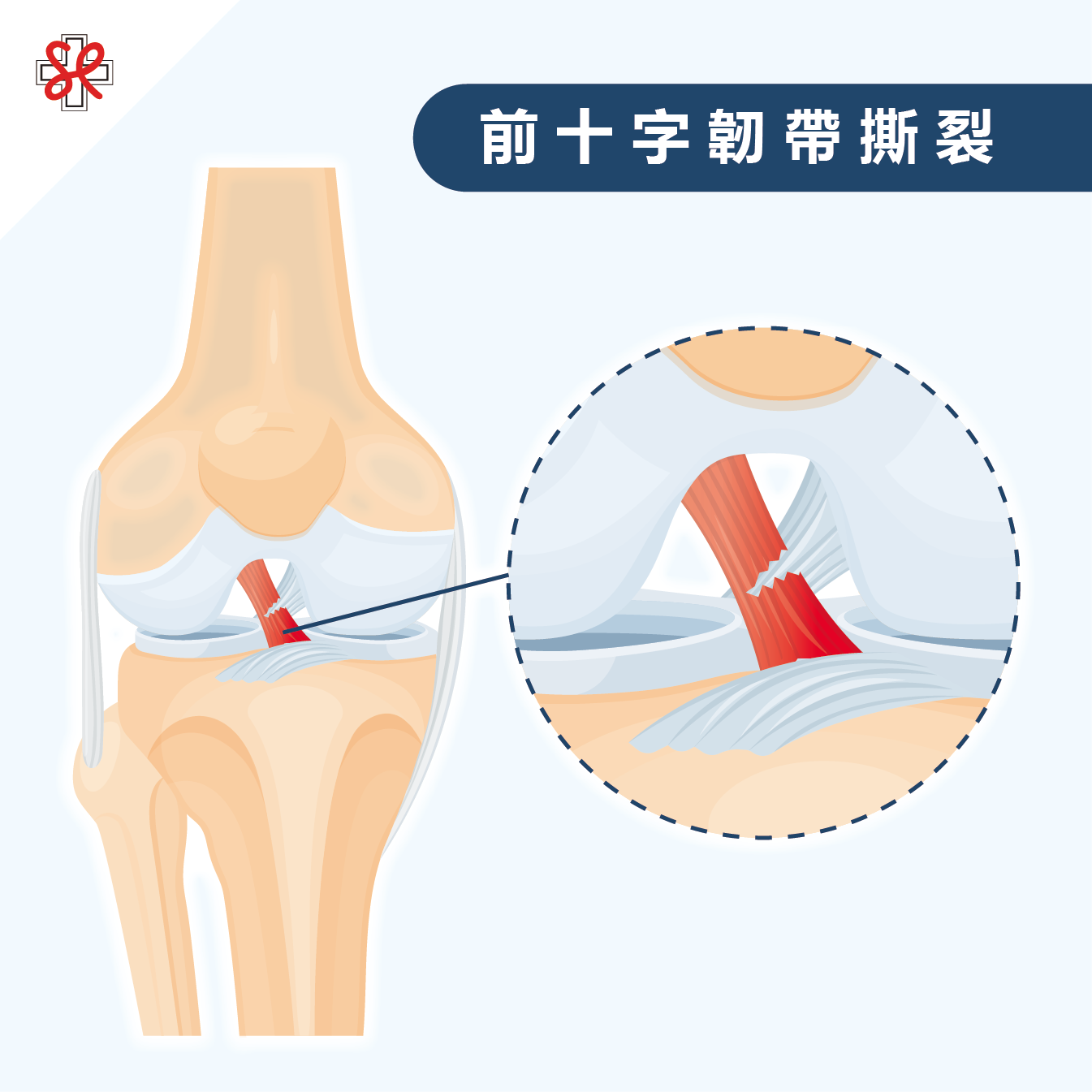 前十字韌帶撕裂