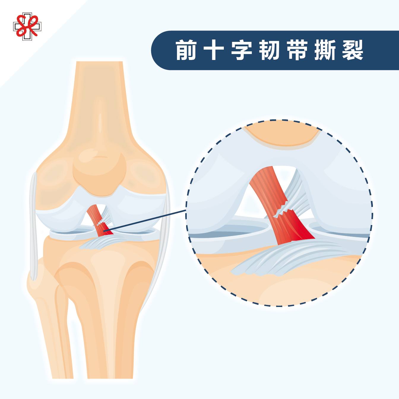 前十字韧带撕裂