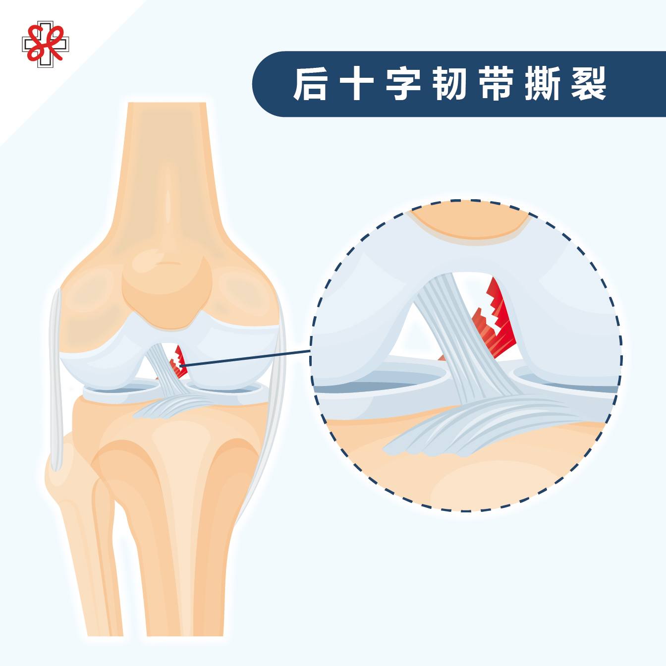 后十字韧带撕裂