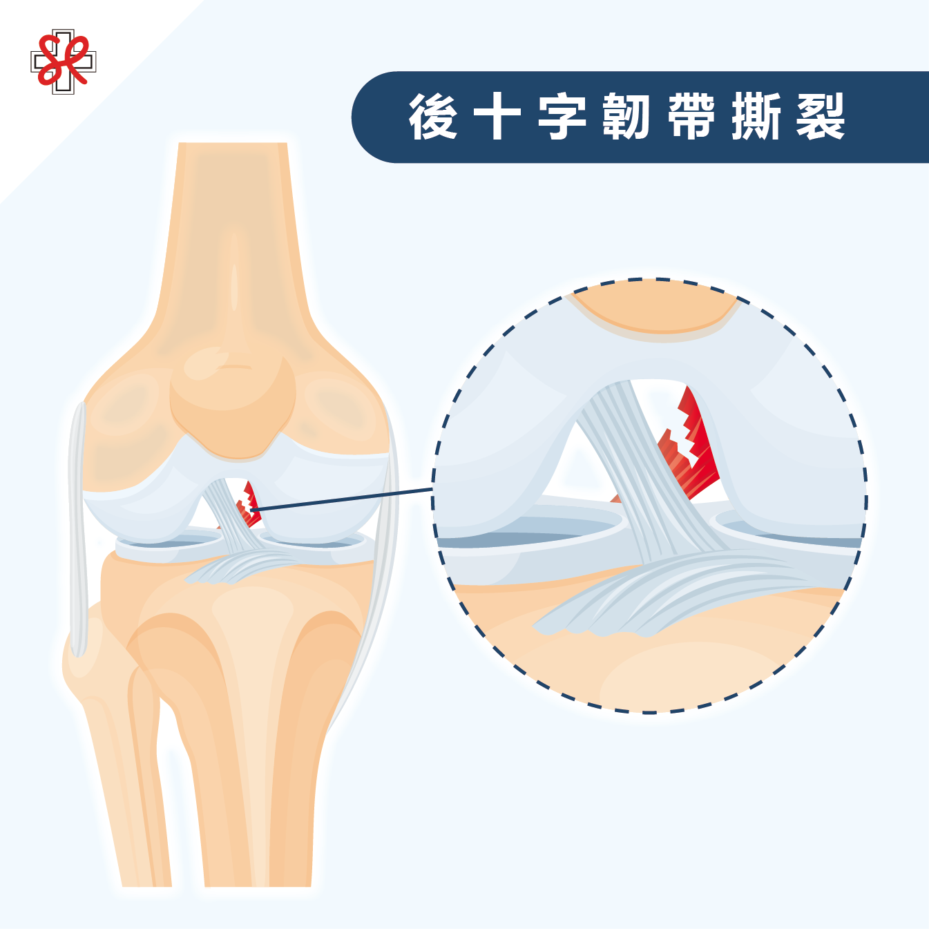 後十字韌帶撕裂