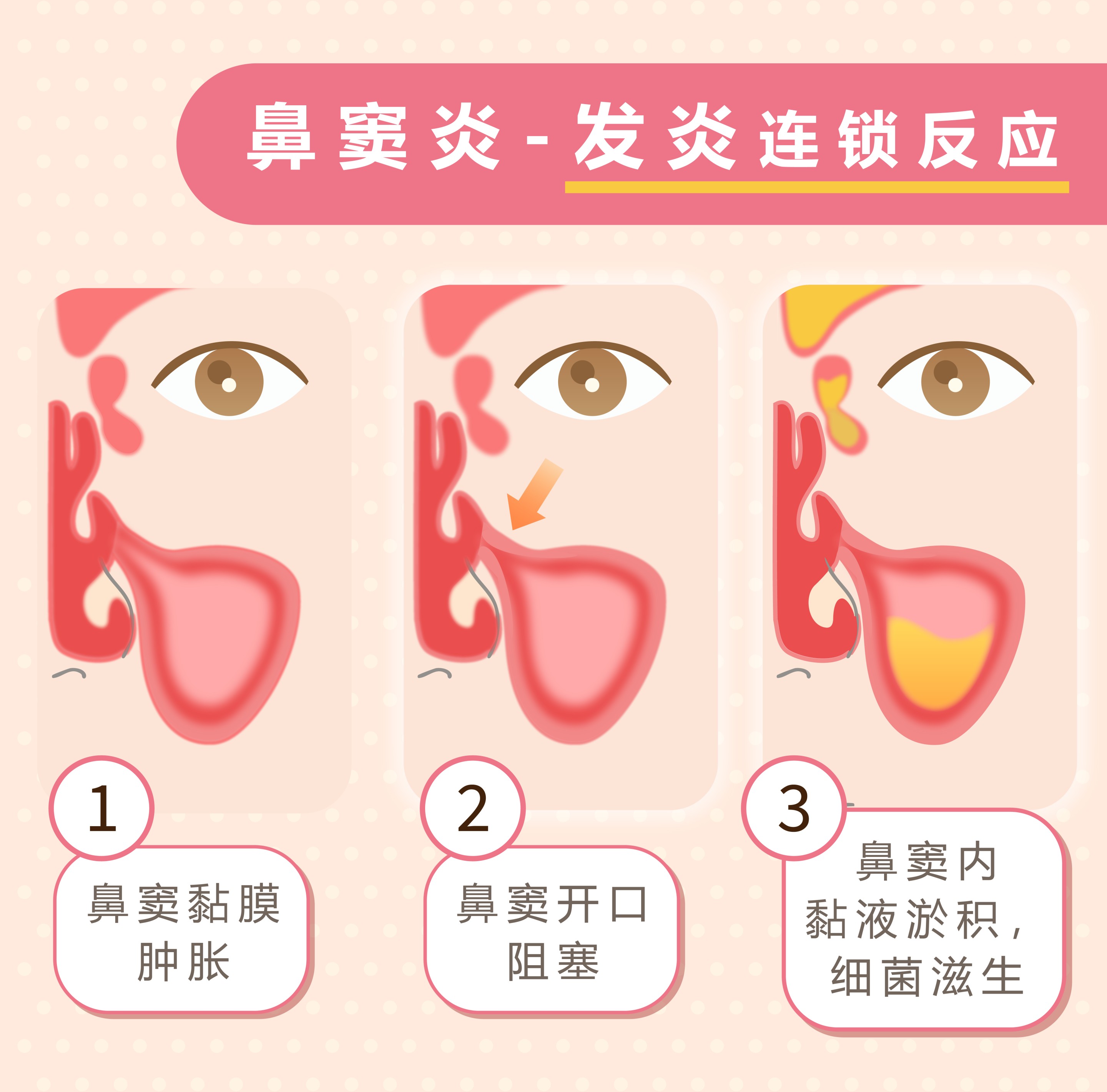 鼻窦炎 发炎连锁反应