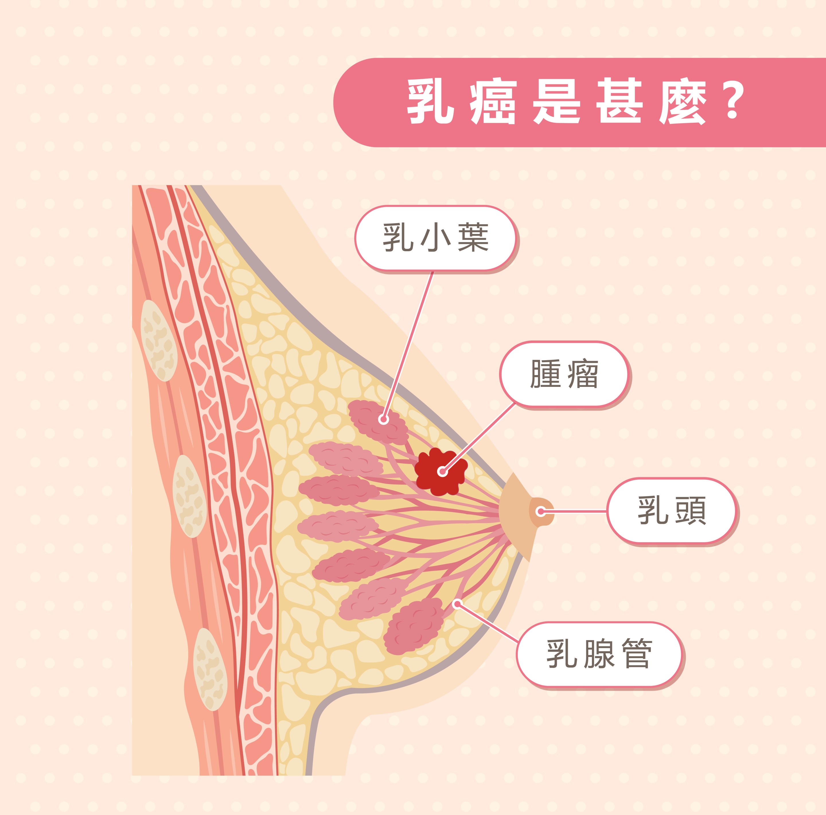 乳癌是甚麼
