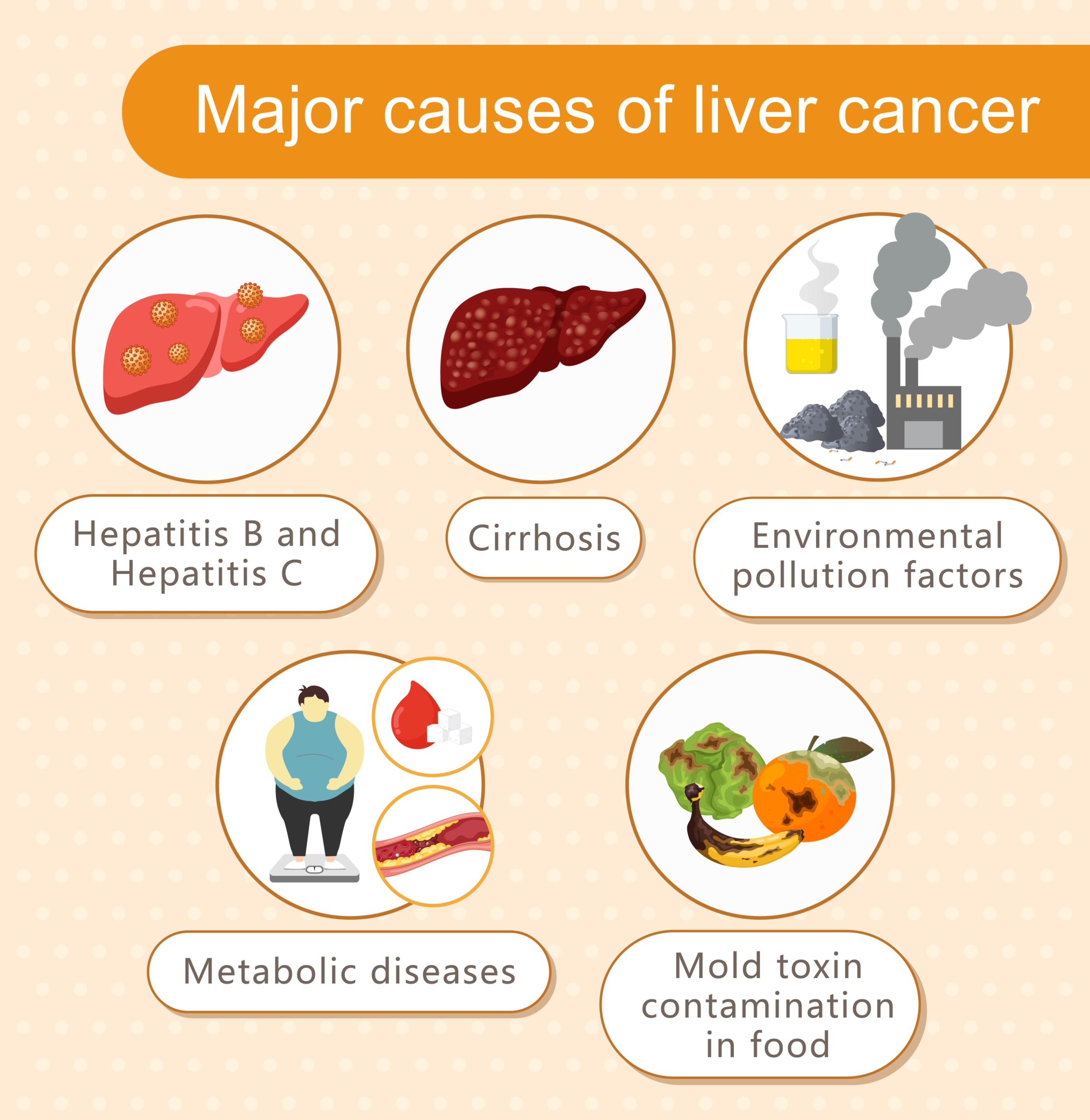 Major causes of liver cancer