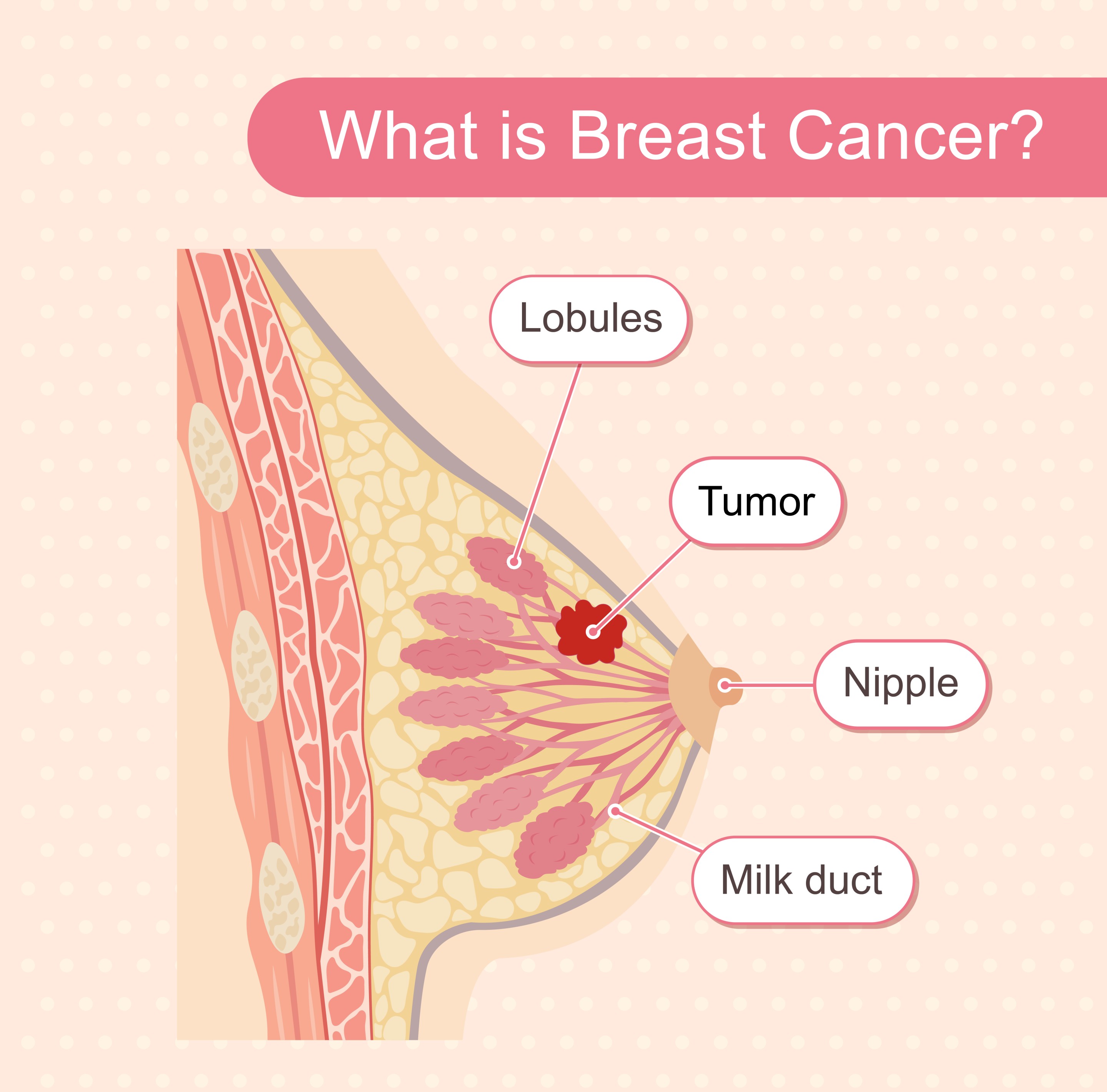 What Is Breast Cancer