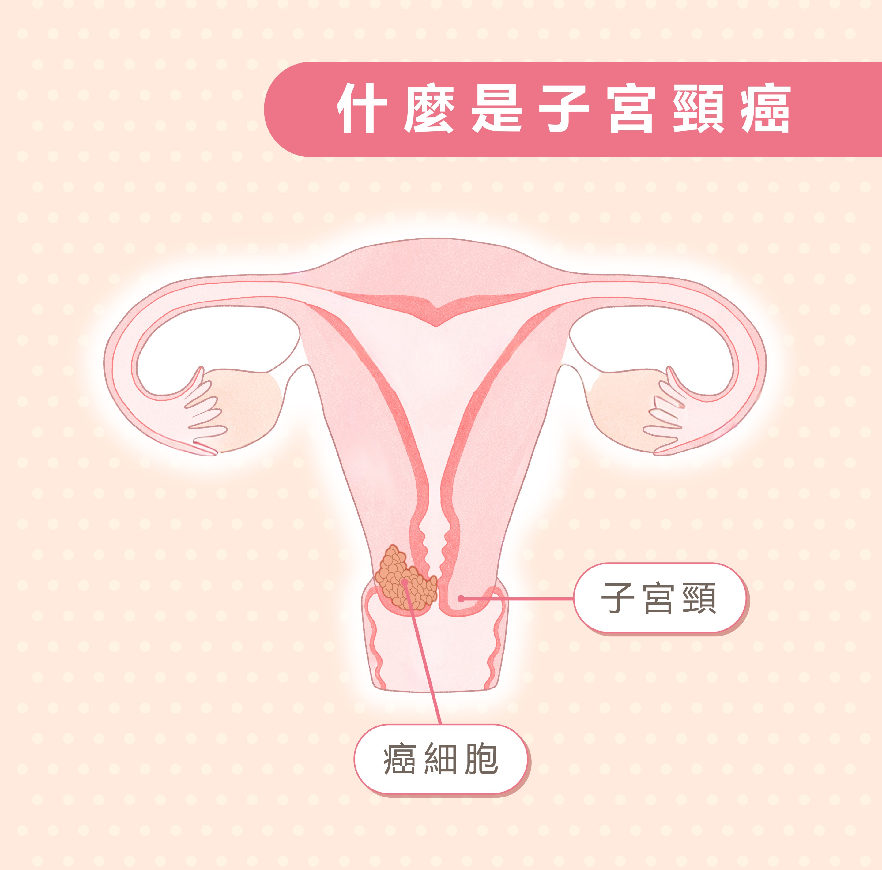 什麼是子宮頸癌