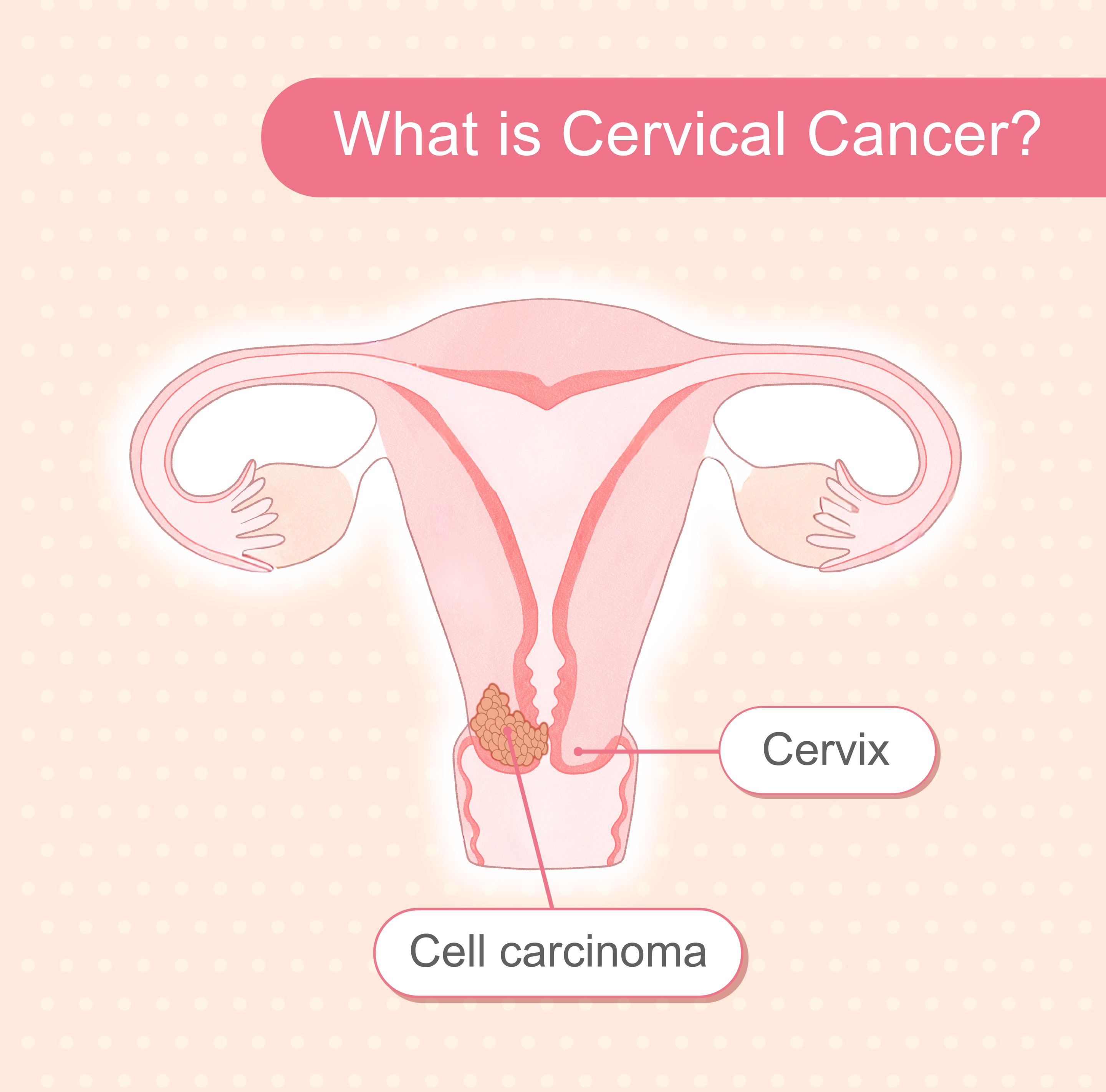What is Cervical Cancer
