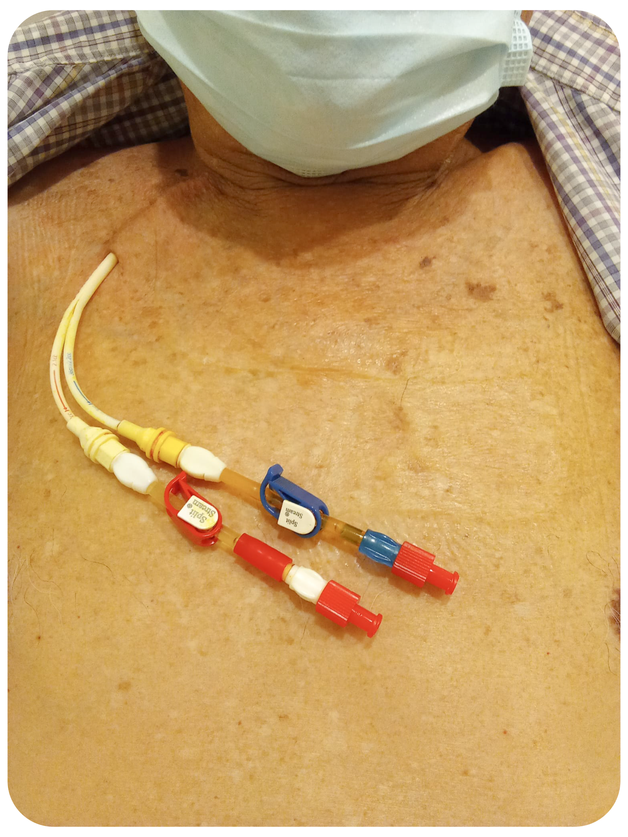 導管 Catheter